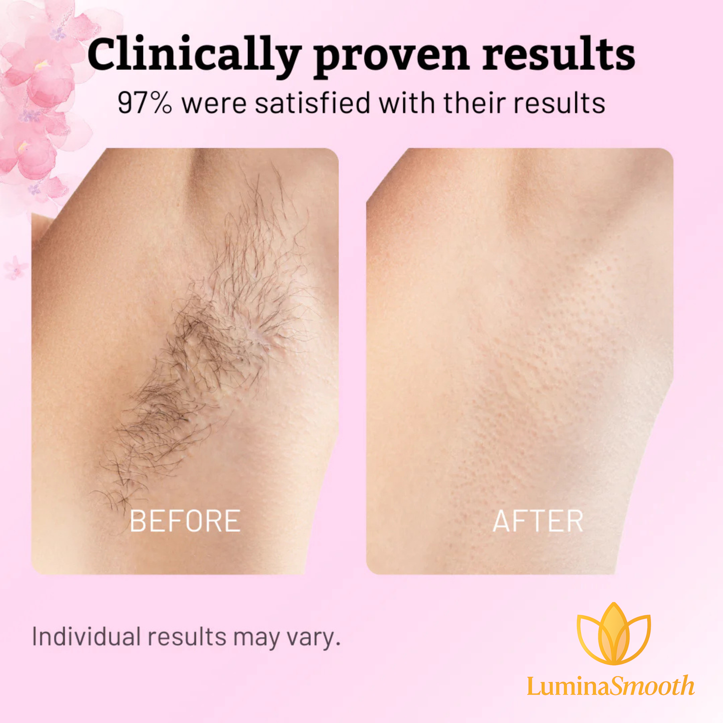 Cyperus Rotundus Oil for Hair Reduction